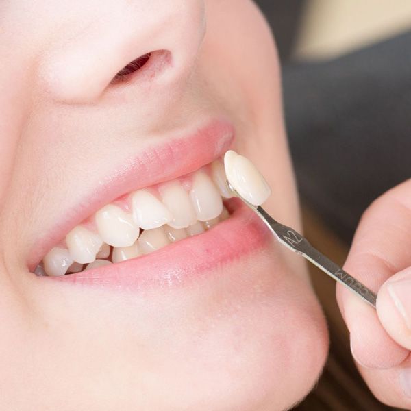 Dentist holding a porcelain veneer to a patient's tooth