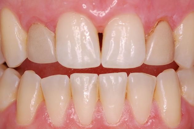 Before veneer placement